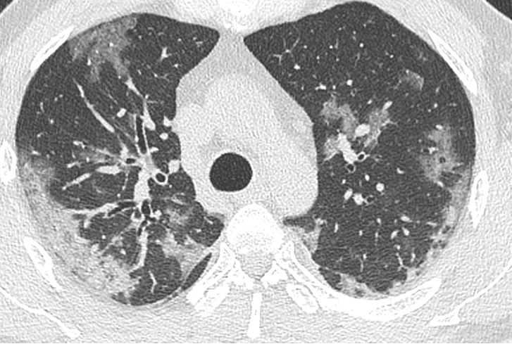 Cas covid numéro 3 image 1